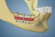 Distraction Osteogensis Post Mandible